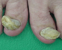 爪 白癬 菌 気になる爪水虫・爪白癬症の症状