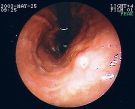 胃角上部の出血性胃潰瘍（動脈が潰瘍底に露出）